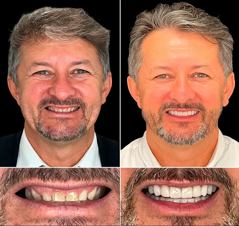 Antes e depois do tratamento de bruxismo - Recuperação do desgaste dental